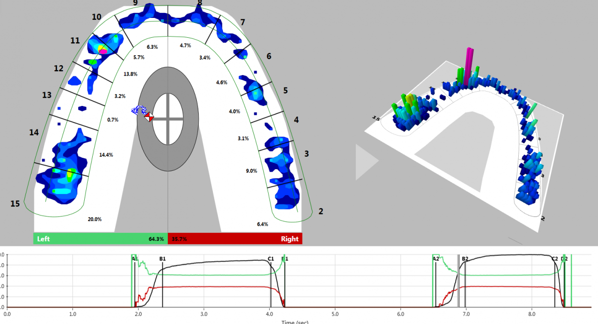 Dental Occlusion Measured with TScan Tekscan